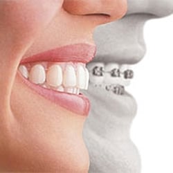 Dentico - In Farbe: Nahezu unsichtbare Invisalign-Zahnspange