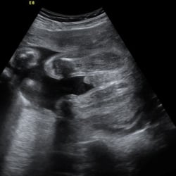 Bows-R-Bowties: 1st Peek 3D/4D Ultrasound - Looks like a boy