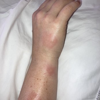 Hampton Inn & Suites Rockland - Bedbugs bites - Hotels Near Me - Thomaston, Maine Hampton Inn & Suites Rockland - Bedbugs bites - Hotels Near Me - Thomaston, Maine