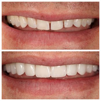 Ventana Dental - Before and after handmade veneers. - General Dentistry Near Me - Tucson, Arizona Ventana Dental - Before and after handmade veneers. - General Dentistry Near Me - Tucson, Arizona