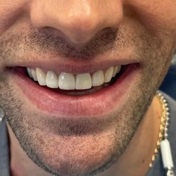 Max Zaslavsky, DMD - Restoration of a missing front tooth with crowns and a single dental implant