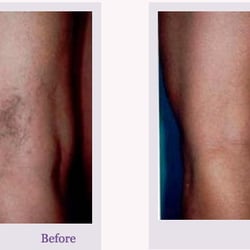 Genesis Health & Beauty - Spider Vein Removal