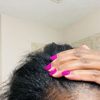 360 Degrees Hair Studio - Burnt Scalp due to HOT BLOWDRYER PROCESS - Hair Salons Near Me - Pearland, Texas 360 Degrees Hair Studio - Burnt Scalp due to HOT BLOWDRYER PROCESS - Hair Salons Near Me - Pearland, Texas