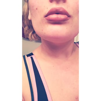 Barrett Plastic Surgery - Thanks so much I love my new lips! - Cosmetic Surgeons Near Me - Beverly Hills, California Barrett Plastic Surgery - Thanks so much I love my new lips! - Cosmetic Surgeons Near Me - Beverly Hills, California