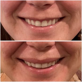Evolve Skin Spa and Wellness - Lip flip- I finally have an upper lip! - Skin Care Near Me - Carlsbad, California Evolve Skin Spa and Wellness - Lip flip- I finally have an upper lip! - Skin Care Near Me - Carlsbad, California