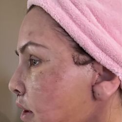 Athré Facial Plastics - Seven days postop