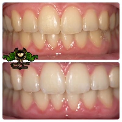 Before and after our services - Check out the difference our teeth whitening service makes on your smile! We use organic and plant-based ingredients to deliver little to no sensitivity. Come and get your appointment booked today!