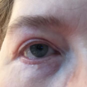Park & Rebowe Clinic for Plastic Surgery - One and a half year post surgery. - Medical Spas Near Me - Mobile, Alabama Park & Rebowe Clinic for Plastic Surgery - One and a half year post surgery. - Medical Spas Near Me - Mobile, Alabama