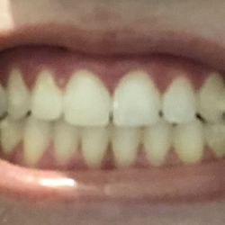 Grand Dentistry of New Port Richey - Almost perfect but still spaces, wish I'd have just accepted & got final retainer!