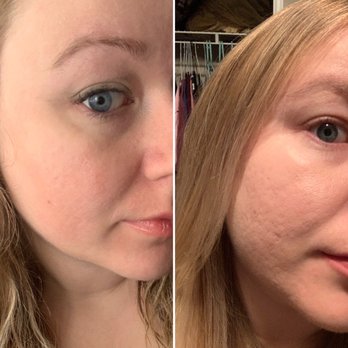 Lakewood Aesthetics - Left is after the second session - Medical Spas Near Me - Dallas, Texas