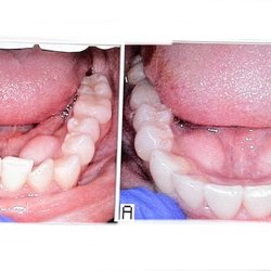 Birdseye Dentistry - My teeth were crowding my tongue that I developed a slight lisp and speech impediment! Not anymore. Plenty of room now.