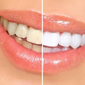 Marc Lippas, DDS - Whiten teeth by 3-5 shades in 1 office visit. We use the powerful yet safe Sapphire system which emits no UV rays. - Cosmetic Dentists Near Me - Dallas, Texas Marc Lippas, DDS - Whiten teeth by 3-5 shades in 1 office visit. We use the powerful yet safe Sapphire system which emits no UV rays. - Cosmetic Dentists Near Me - Dallas, Texas