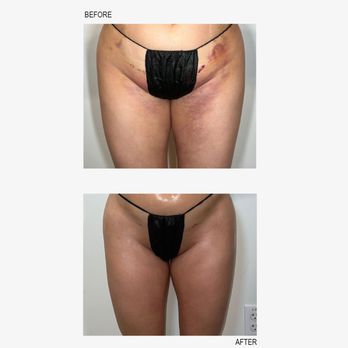 Truly Snatched Body Contouring - A Manual Lymphatic Drainage helps to prevent fibrosis, after lip suction book today! - Body Contouring Near Me - Pasadena, California Truly Snatched Body Contouring - A Manual Lymphatic Drainage helps to prevent fibrosis, after lip suction book today! - Body Contouring Near Me - Pasadena, California