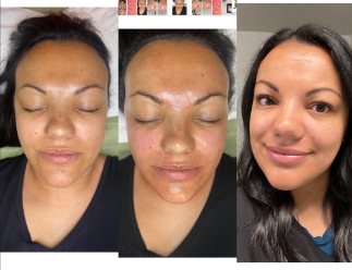 Dermaplane & Microneedle Special! - Get the ultimate exfoliating & rejuvenating facial treatment-Dermaplaning followed by microneedling with CBD infused hyaluronic serum, hydrating mask and healing balm! Best facial in Denver! Dermaplane & Microneedle Special! - Get the ultimate exfoliating & rejuvenating facial treatment-Dermaplaning followed by microneedling with CBD infused hyaluronic serum, hydrating mask and healing balm! Best facial in Denver!