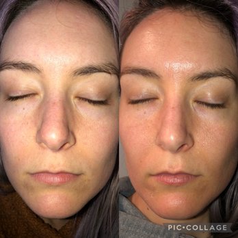 Glow DermSolutions - left before; right - after - Medical Spas Near Me - San Jose, California Glow DermSolutions - left before; right - after - Medical Spas Near Me - San Jose, California