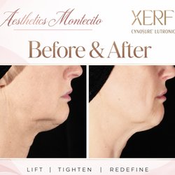 Aesthetics Montecito - Lift. Tighten. Redefine. XERF is now at Aesthetics Montecito. Book your consult: (805) 708-6818 #XERF #AestheticsMontecito