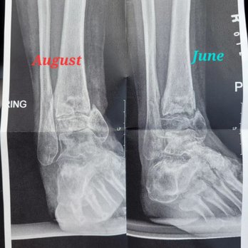 Barrington Orthopedic Specialists - Progress scans of my tibial pilon fracture - Orthopedists Near Me - Schaumburg, Illinois Barrington Orthopedic Specialists - Progress scans of my tibial pilon fracture - Orthopedists Near Me - Schaumburg, Illinois