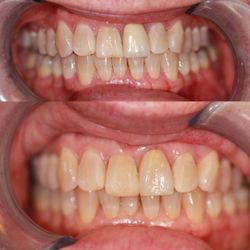 May Y.  Huang, DDS - Evergreen Dental Group - Before: an old style crown with poorly matched color. 
After: new crown with updated material and much better matched esthetic.