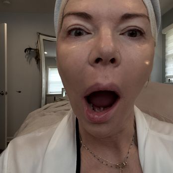 Injx By Nat - After - Medical Spas Near Me - Cranford, New Jersey