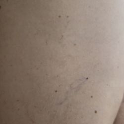 Ego Beauty & Wellness Defined - Capillaries,
