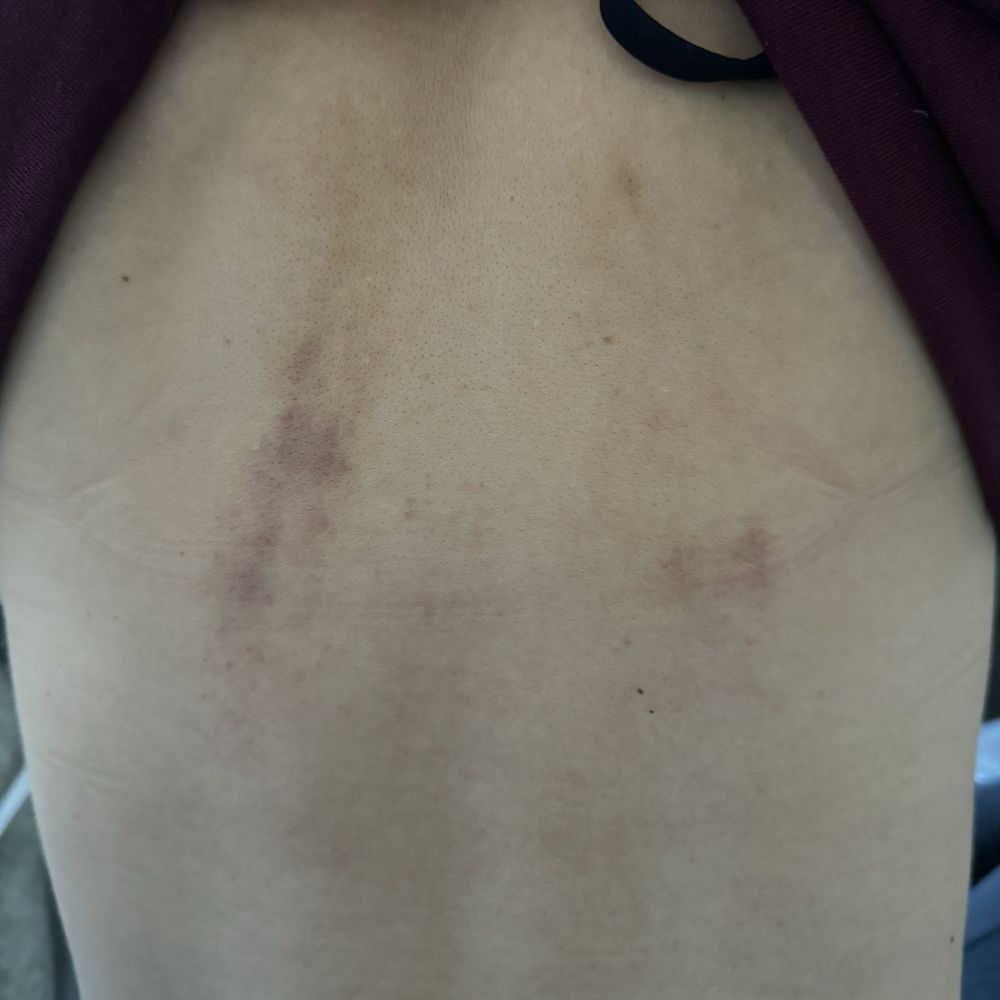 Bruises from massage