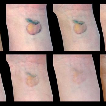 Removery Tattoo Removal & Fading - Tattoo Removal Near Me - Ottawa, Ontario Removery Tattoo Removal & Fading - Tattoo Removal Near Me - Ottawa, Ontario