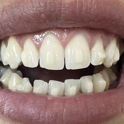 Kharen Minasyan, DDS - MK Dental Office - First day of Invisalign