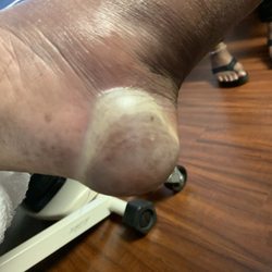 Pruitt Health Care of Augusta Hills - Stage 2 pressure ulcer to heel