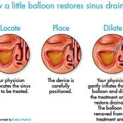Foothill ENT Care Specialists - Balloon Sinus Dilation. The office based solution to traditional surgery. In and out in about 1 hr. Back to work the next day.