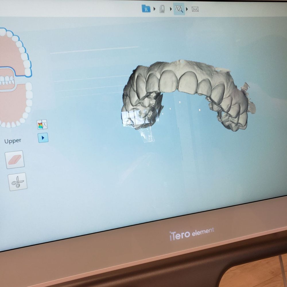 Messenger Orthodontics - Intraoral scan... Amazing technology! - Orthodontists Near Me - Huntington Beach, California Messenger Orthodontics - Intraoral scan... Amazing technology! - Orthodontists Near Me - Huntington Beach, California