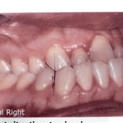 Kingsway Oral & Maxillofacial Surgery - My teeth when we started as a result of an accident when I was a child