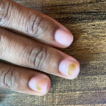 Perfect Fingers - Fungus - Nail Salons Near Me - San Francisco, California Perfect Fingers - Fungus - Nail Salons Near Me - San Francisco, California