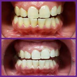 Great White Smiles - Great White Smiles before and after photo. This client chose our Advanced Treatment.