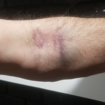 Tulsa Men's Clinic - Bruises from phlebotomist - Weight Loss Centers Near Me - Tulsa, Oklahoma Tulsa Men's Clinic - Bruises from phlebotomist - Weight Loss Centers Near Me - Tulsa, Oklahoma