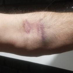 Tulsa Men's Clinic - Bruises from phlebotomist