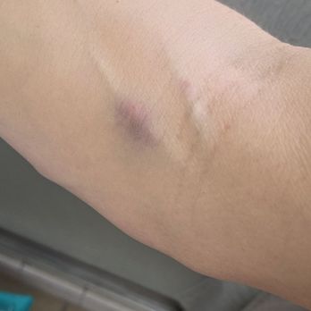 Parexel Los Angeles - 2 of the unnecessary painful 3 pokes done within minutes - Psychiatrists Near Me - Glendale, California Parexel Los Angeles - 2 of the unnecessary painful 3 pokes done within minutes - Psychiatrists Near Me - Glendale, California