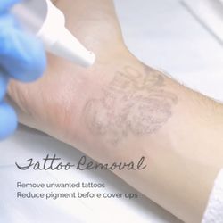Derma Fx Medispa - Laser Tattoo Removal