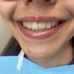 Inglewood Dental & Orthodontics - My daughter's smile. Don't mind her sunburned lips, she was at camp all week, lol.
