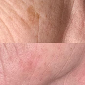 Duluth Med Spa - Dark age spot in top pic. After IPL Laser. - Acne Treatment Near Me - Duluth, Minnesota Duluth Med Spa - Dark age spot in top pic. After IPL Laser. - Acne Treatment Near Me - Duluth, Minnesota