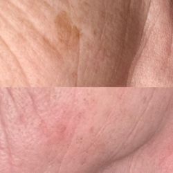 Dark age spot in top pic. After IPL Laser.