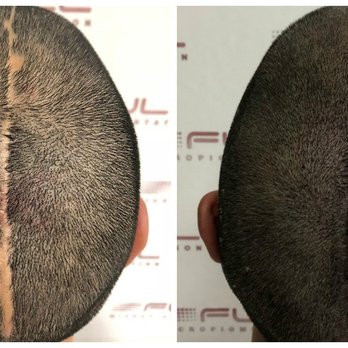 Full Micropigmentation - Hair Loss Centers Near Me - Newport Beach, California