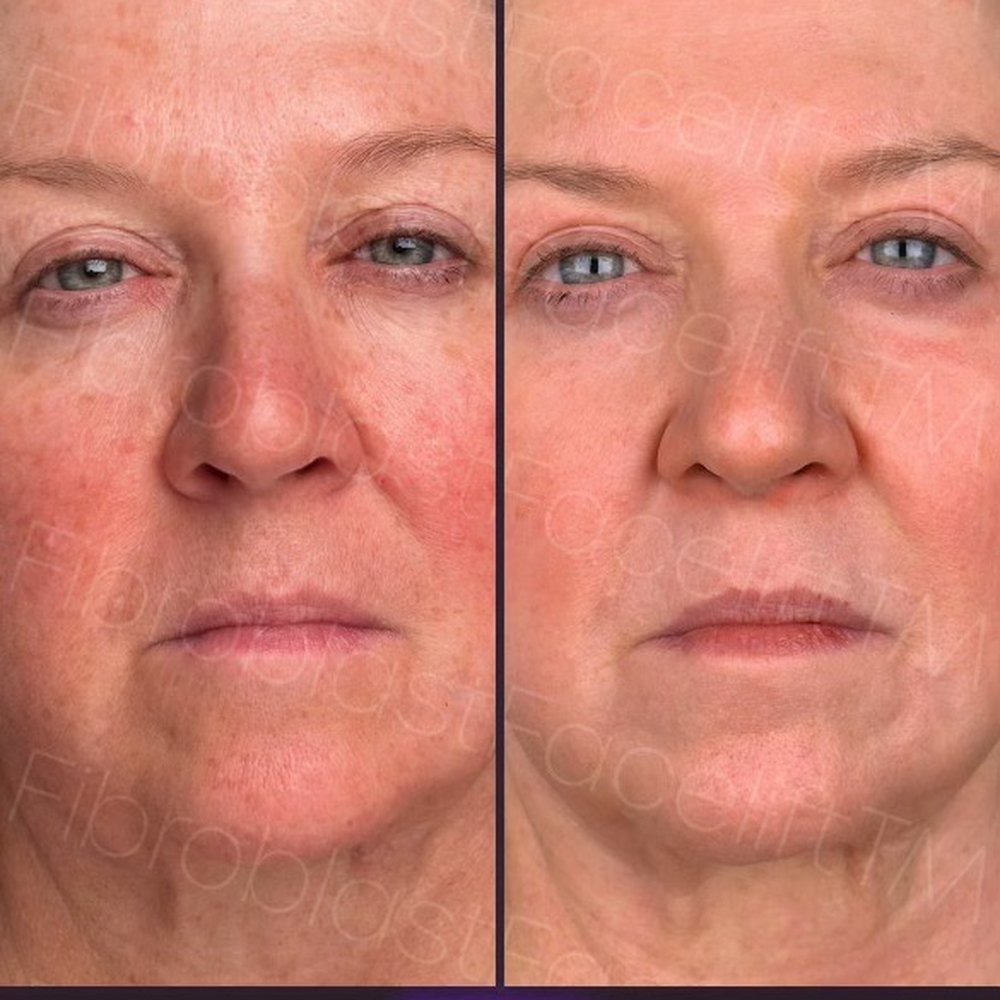 Before my Fibroblast facelift and three months after, side-by-side photos.
