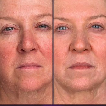 Fibroblast Facelift - Before my Fibroblast facelift and three months after, side-by-side photos. - Skin Care Near Me - Pasadena, California Fibroblast Facelift - Before my Fibroblast facelift and three months after, side-by-side photos. - Skin Care Near Me - Pasadena, California
