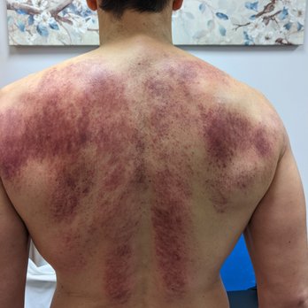 Innovative Body Concepts - Dynamic cupping shows where I needed better blood flow for healing. - Weight Loss Centers Near Me - San Francisco, California Innovative Body Concepts - Dynamic cupping shows where I needed better blood flow for healing. - Weight Loss Centers Near Me - San Francisco, California