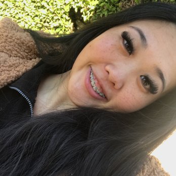 Unique Orthodontics - 3 weeks before removal - Orthodontists Near Me - Clovis, California