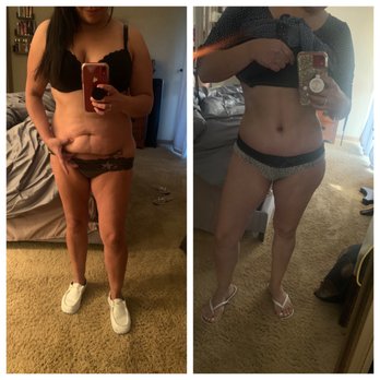Tri Valley Plastic Surgery - These results were 4 weeks later, final results can take 3 to 4 months. Instant satisfaction to say the least ! - Medical Spas Near Me - Dublin, California