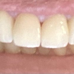 Dental 4 - My top teeth! Had crowns done. Going back for bottom row soon!