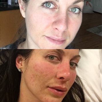 Skin365 - Melasma before and after microneedling - Skin Care Near Me - Torrance, California Skin365 - Melasma before and after microneedling - Skin Care Near Me - Torrance, California