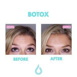 RenewMe IV Therapy & Medspa - Botox