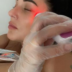 RF Facial